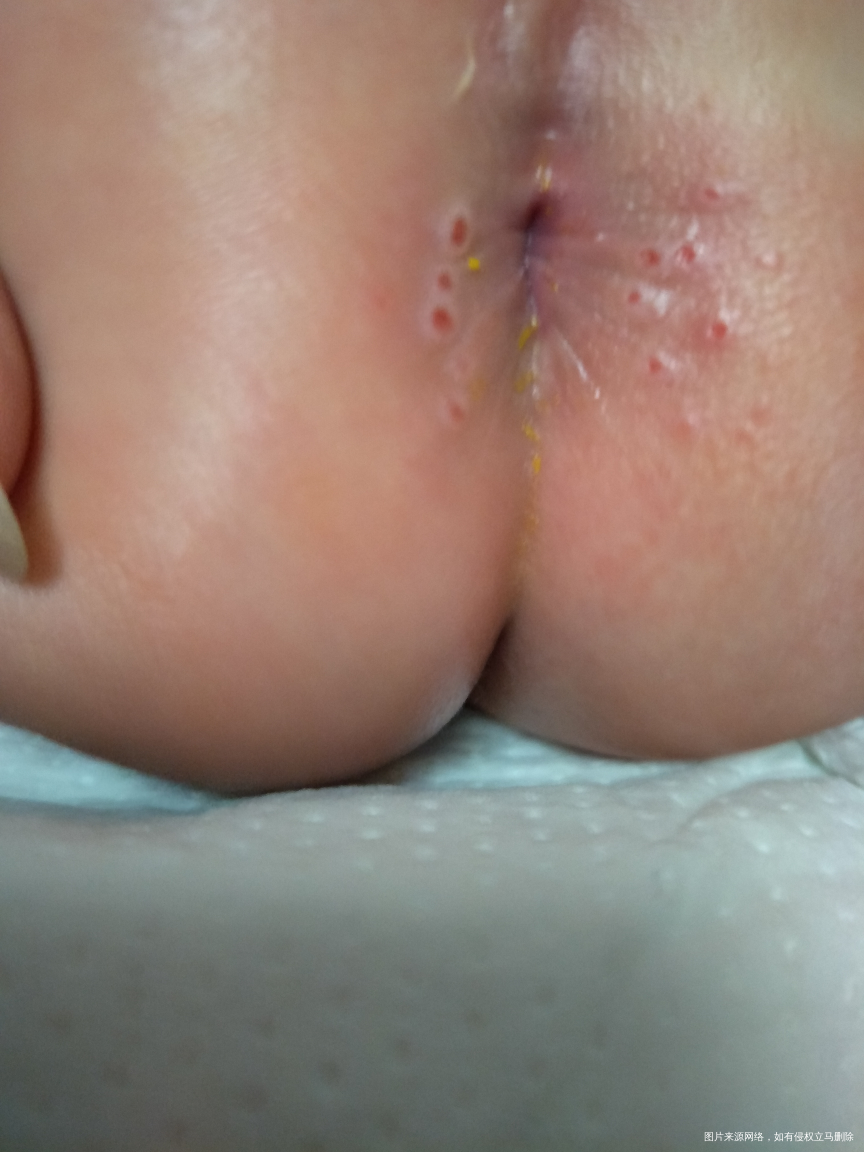 宝宝拉粑粑的地方起红点点,生下来的时候没有的 不过月子里起的🙏🙏🙏