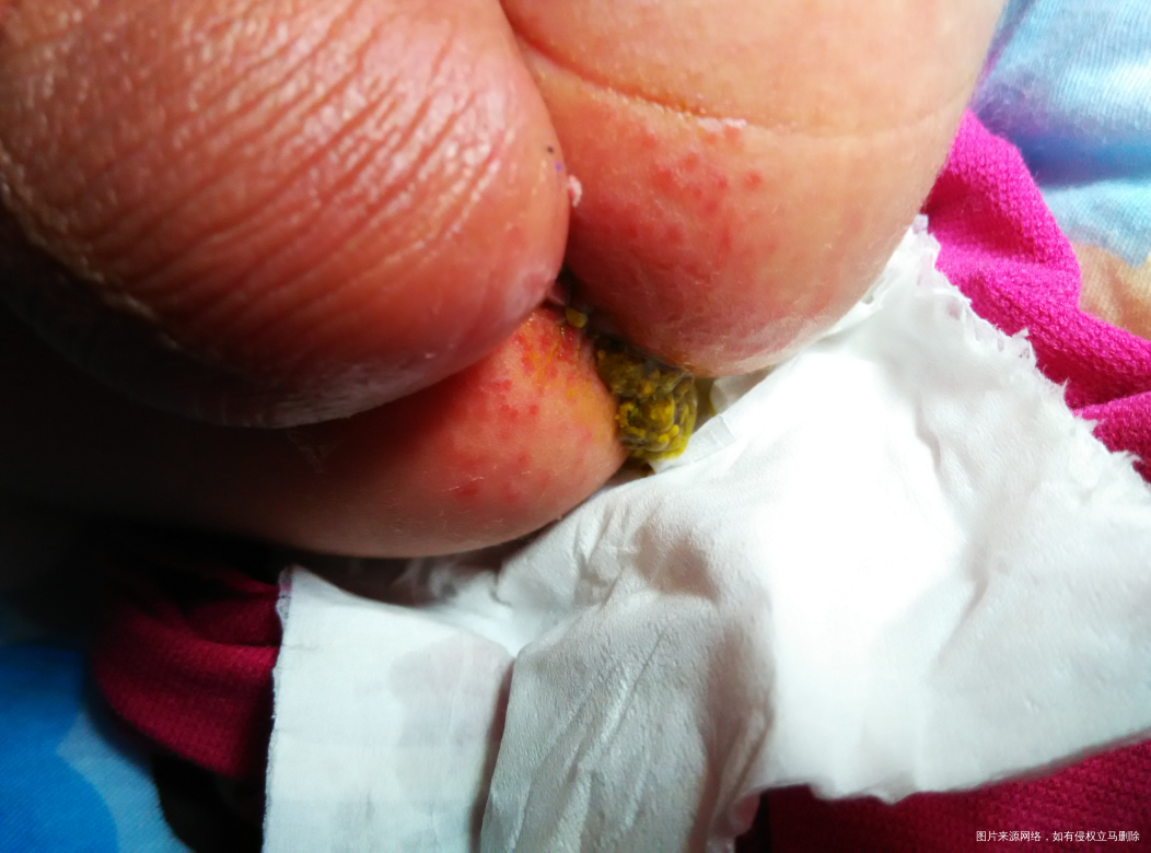 宝宝出生十天,吃茵栀黄拉了好多天