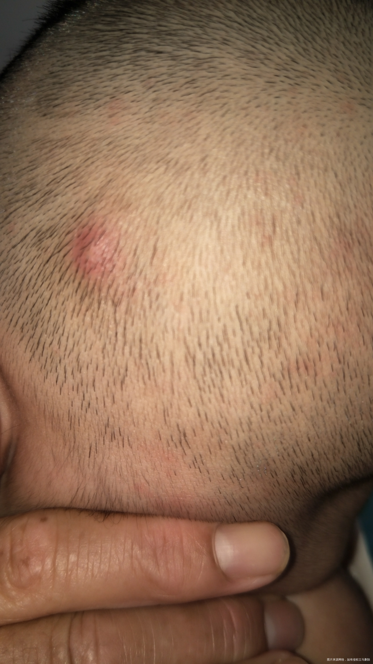 麻烦医生看下宝宝头皮长了个红疙瘩