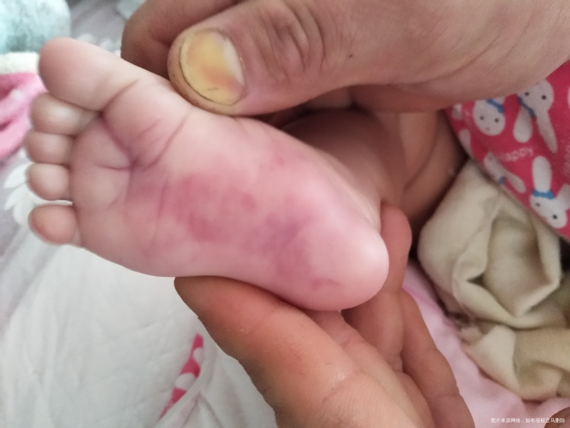 两个月的宝宝脚底发紫怎么回事?