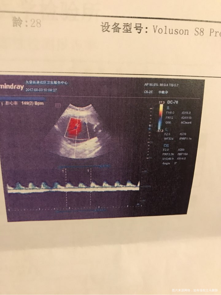 孕17周中期唐筛检查结果,有经验的姐妹们帮我看看