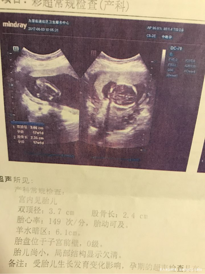 孕17周中期唐筛检查结果,有经验的姐妹们帮我看看