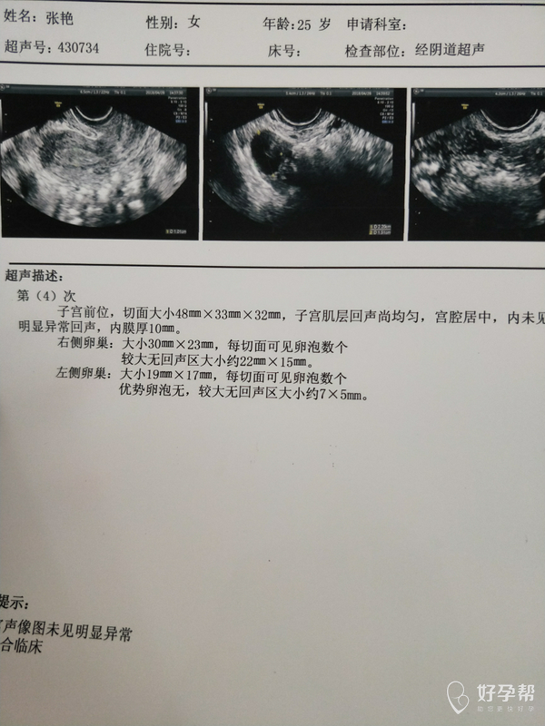 今天晚上可以安排一次同房,明天继续b超监测卵泡发育