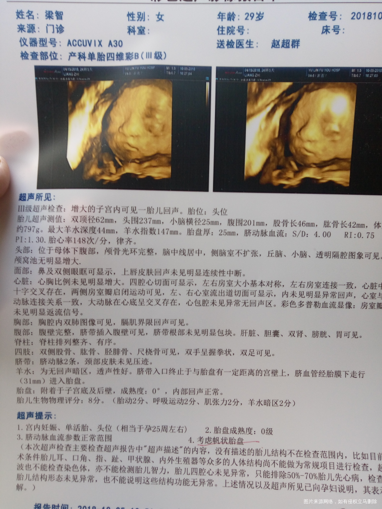 前几天做的四维,帮忙看下正常吗?