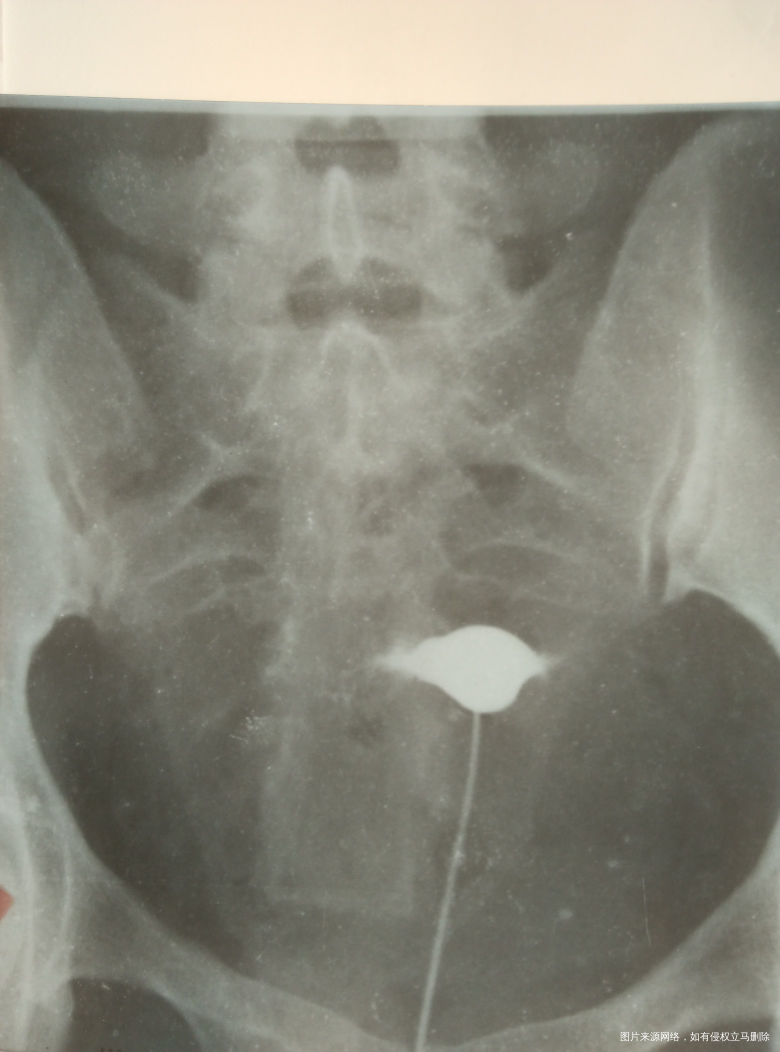 双侧输卵管堵塞做手术有希望吗?谢谢!