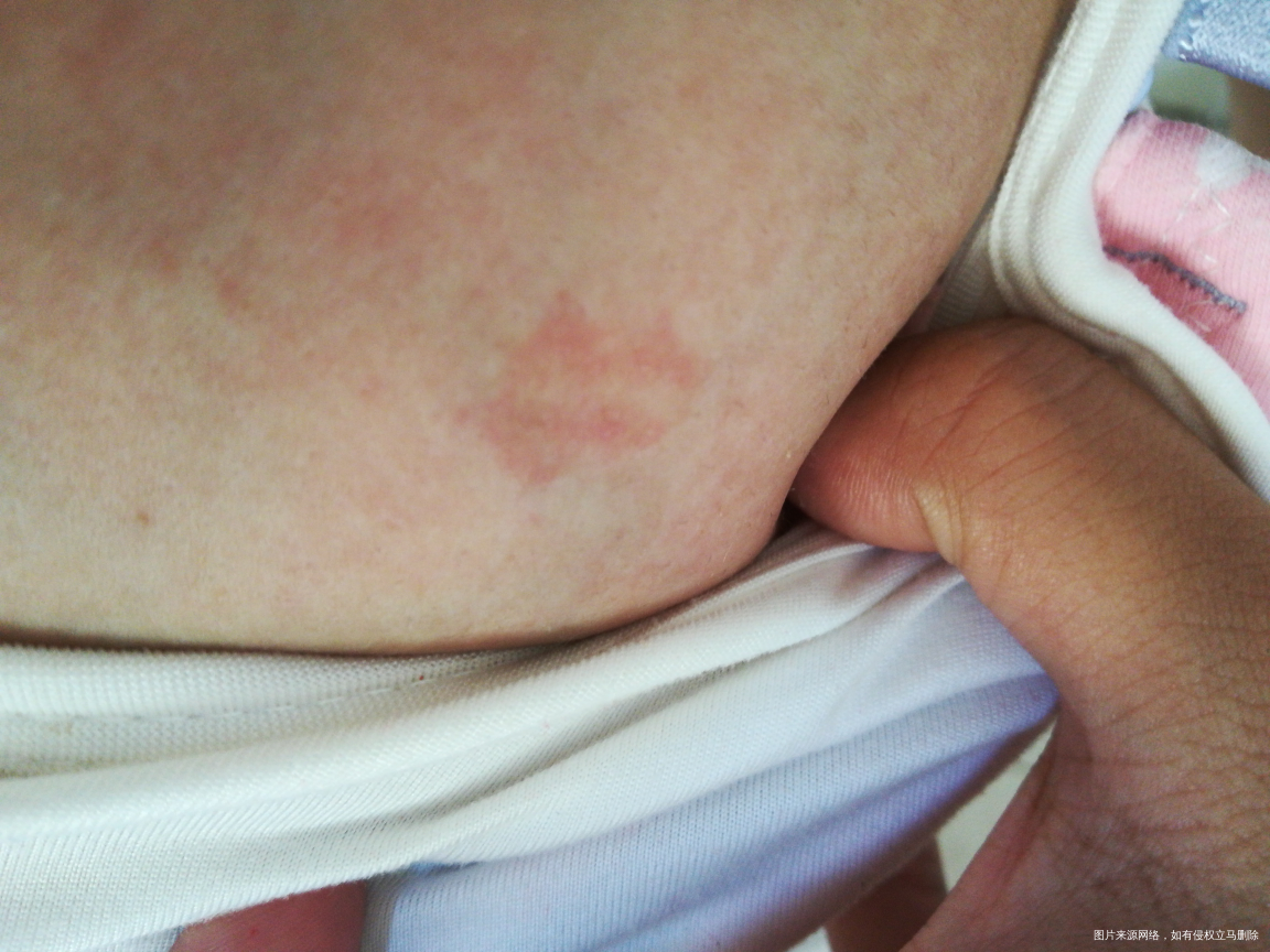 怀孕期间身上长了红色的斑,而且还脱皮!