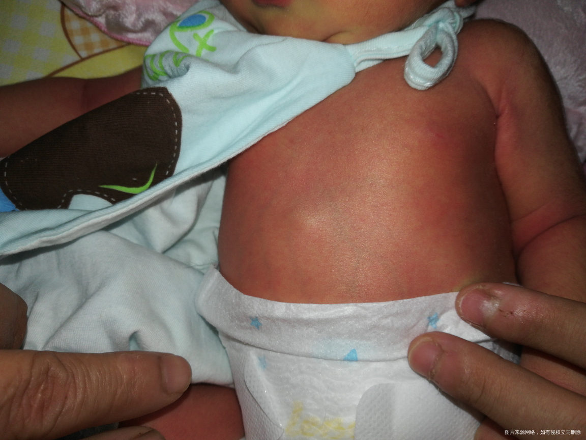 刚出生七天的宝宝。胸口有一个突出来的肉球。