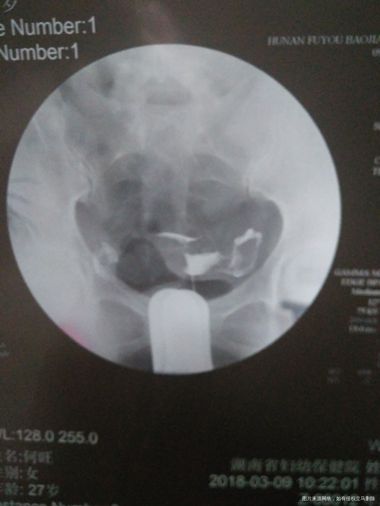 输卵管造影回来...请各位医生给些建议!