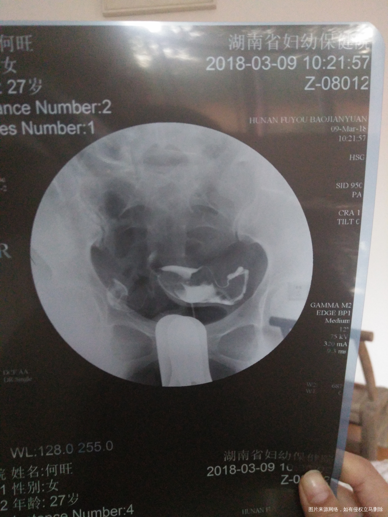 输卵管造影回来...请各位医生给些建议!