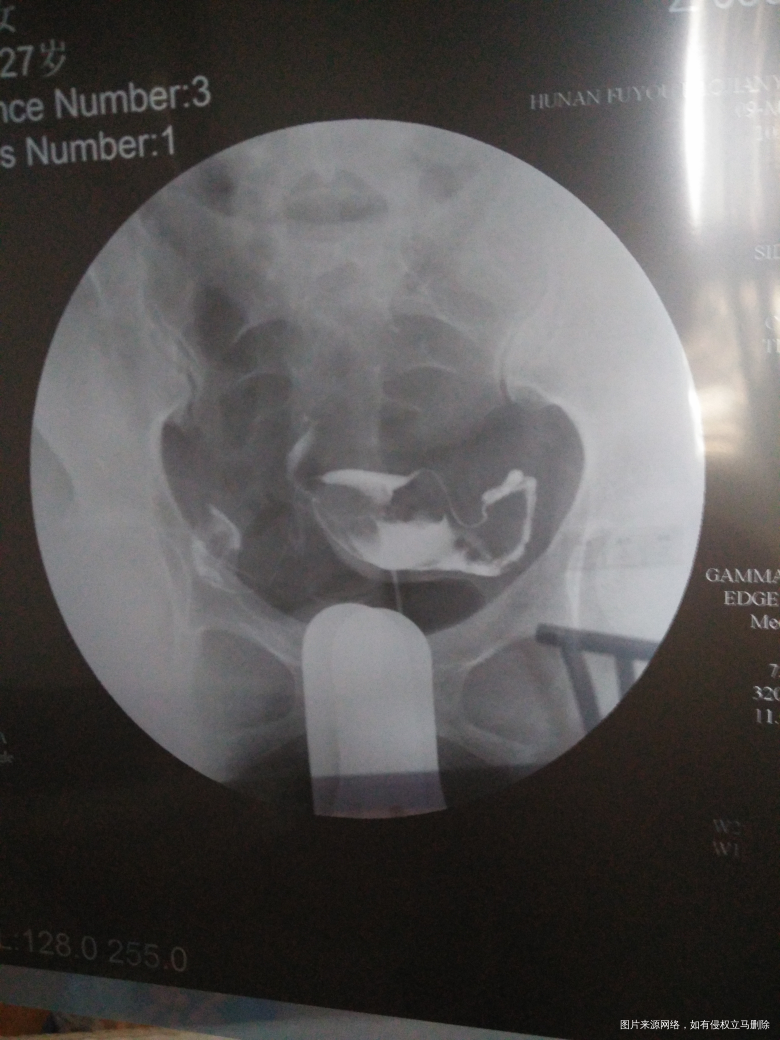 输卵管造影回来...请各位医生给些建议!