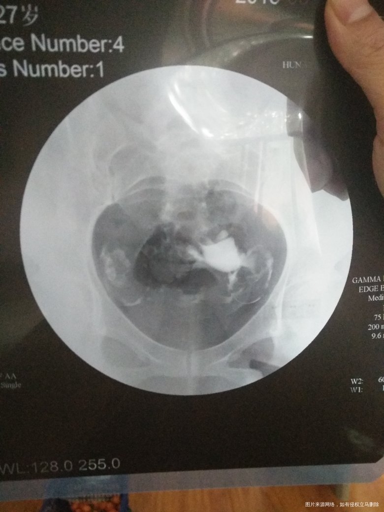 输卵管造影回来...请各位医生给些建议!