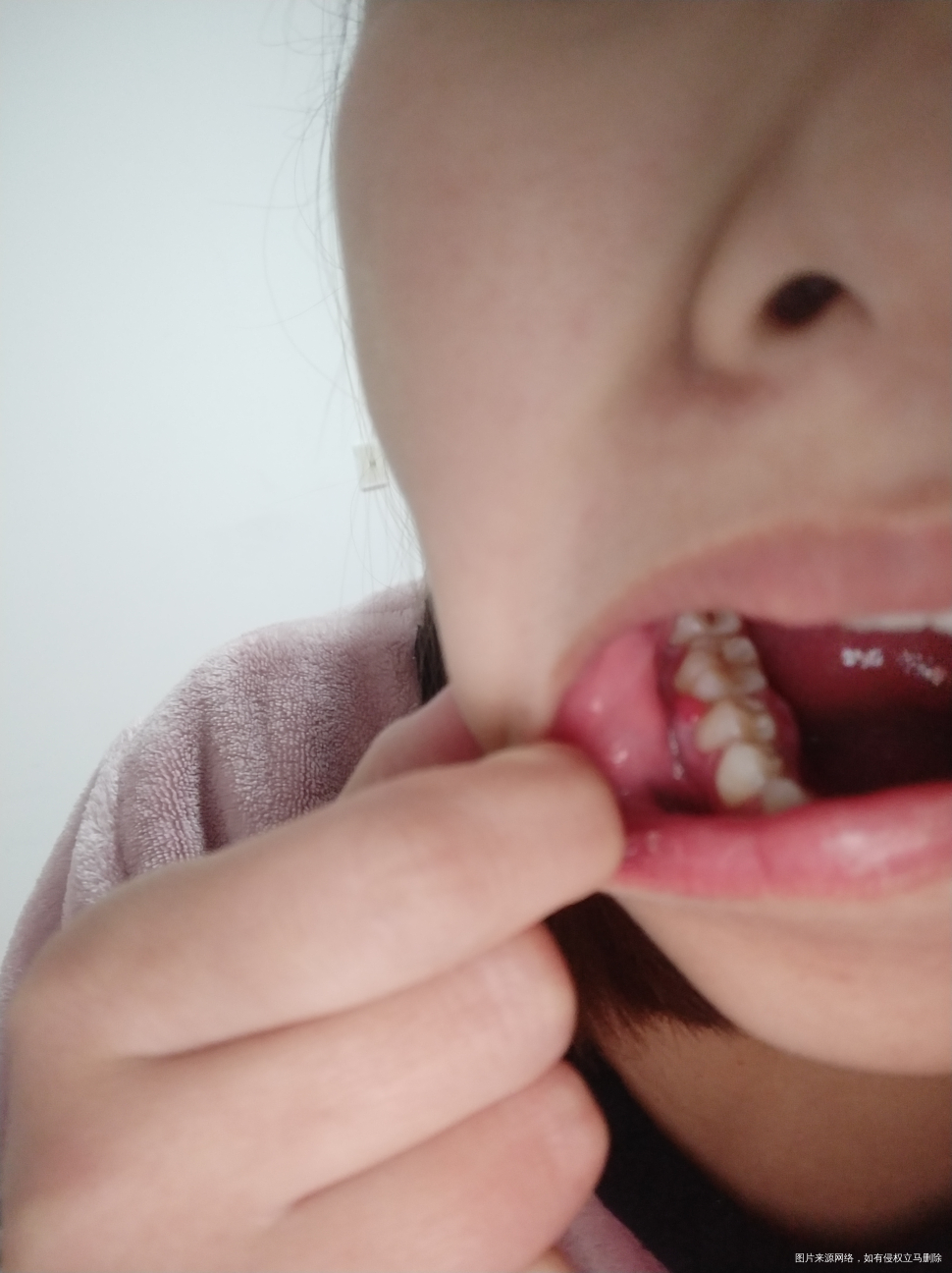 怀孕五个多月了,牙龈肿了。