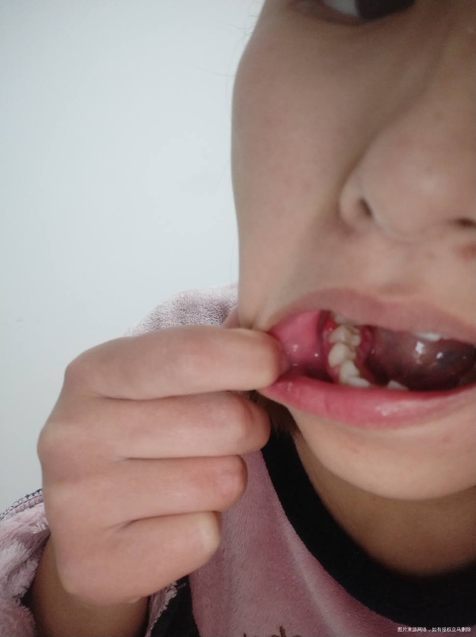 怀孕五个多月了,牙龈肿了。