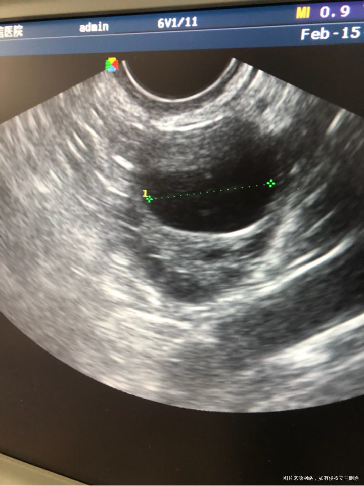 今天周期第21天,内膜0.75卵泡2.3×1.5