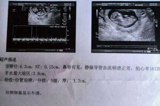 分享我多囊、闭经的好孕之路，幸福总在不经意之间