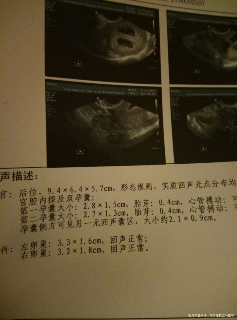 【我怀啦】一超顺利通过啦!居然是双胎