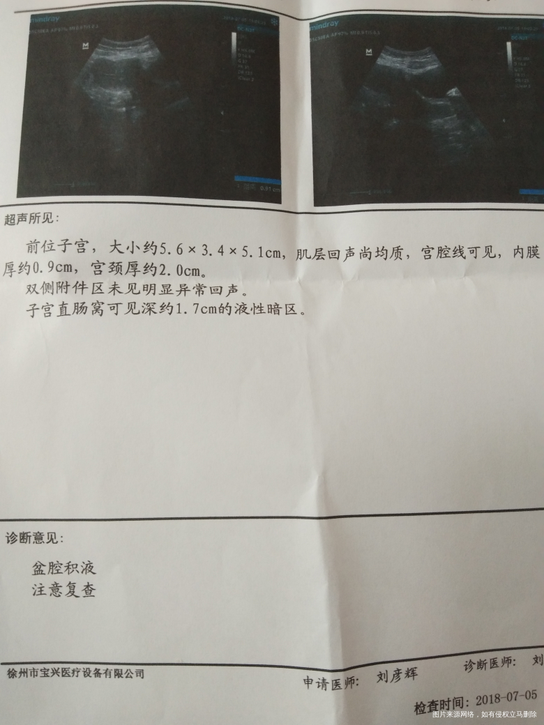 是排卵了吗?盆腔积液而且有点多