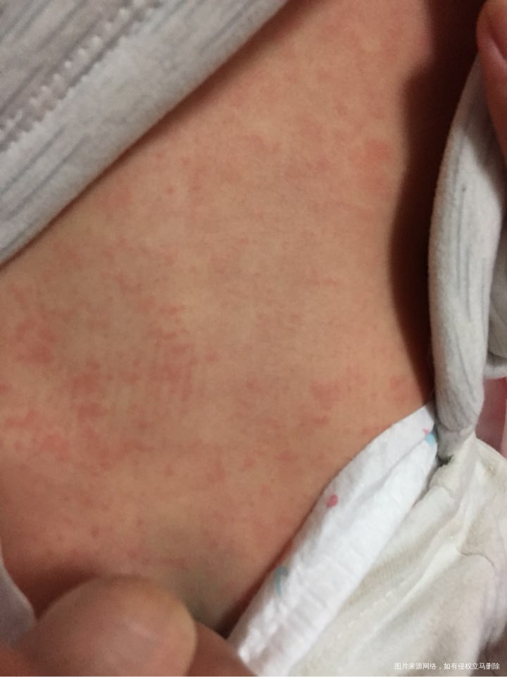 急,宝宝今天身上起了好多这种红点点,怎么办呢?