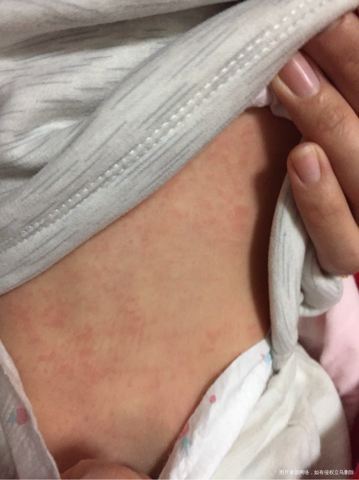 急,宝宝今天身上起了好多这种红点点,怎么办呢?