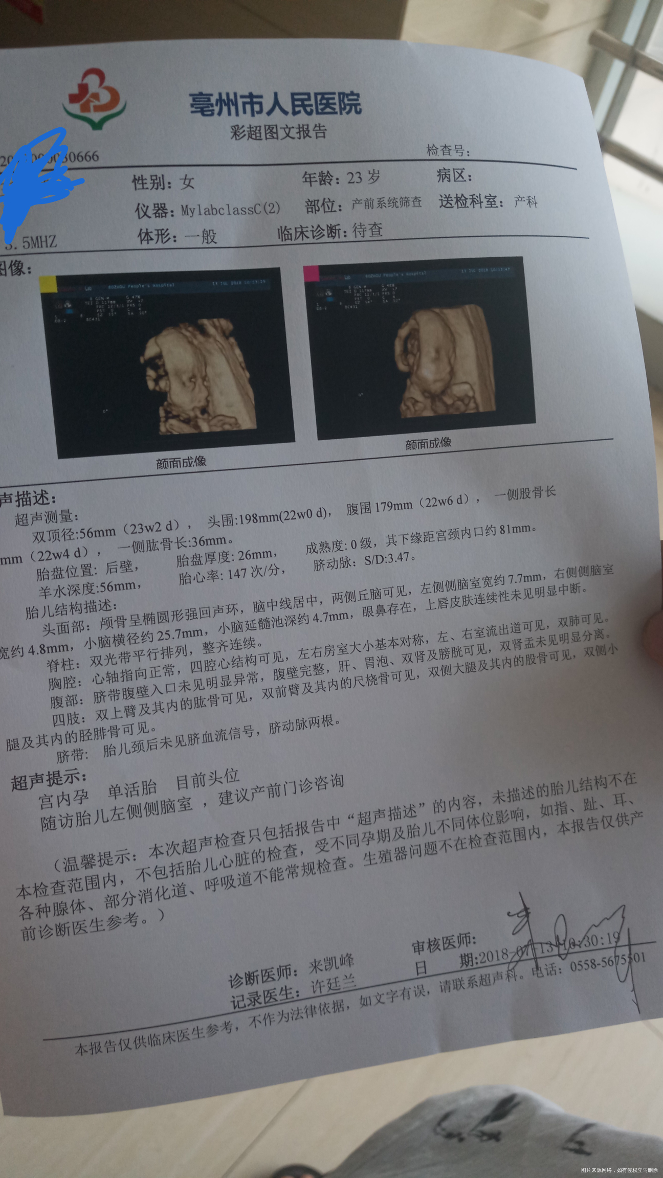 b超大排崎左侧侧脑室宽7.7mm正常吗,