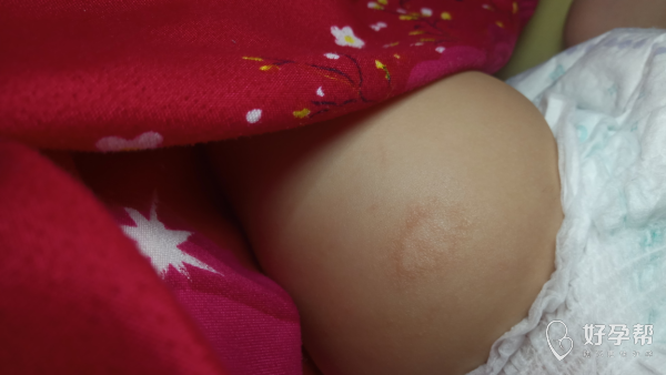 五个多月宝宝腿上有一块干燥皮癣,是什么东西啊