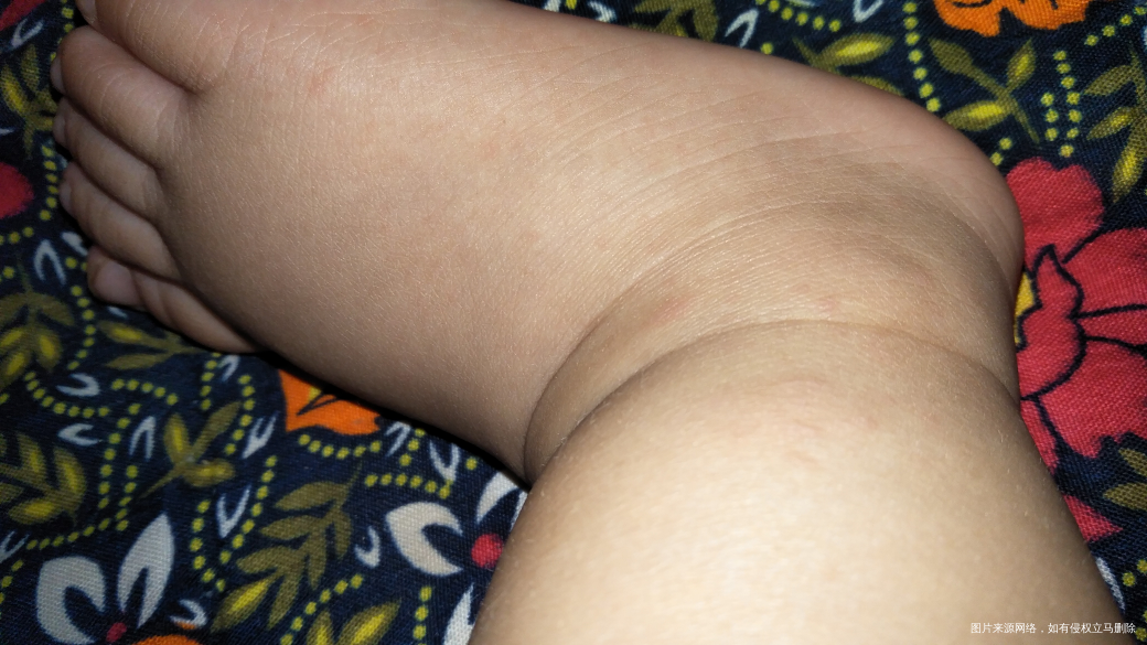 孩子手上最近多了几个白色的包