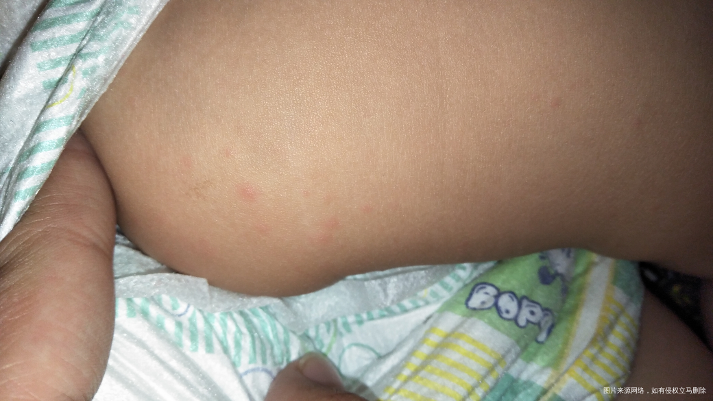 孩子手上最近多了几个白色的包