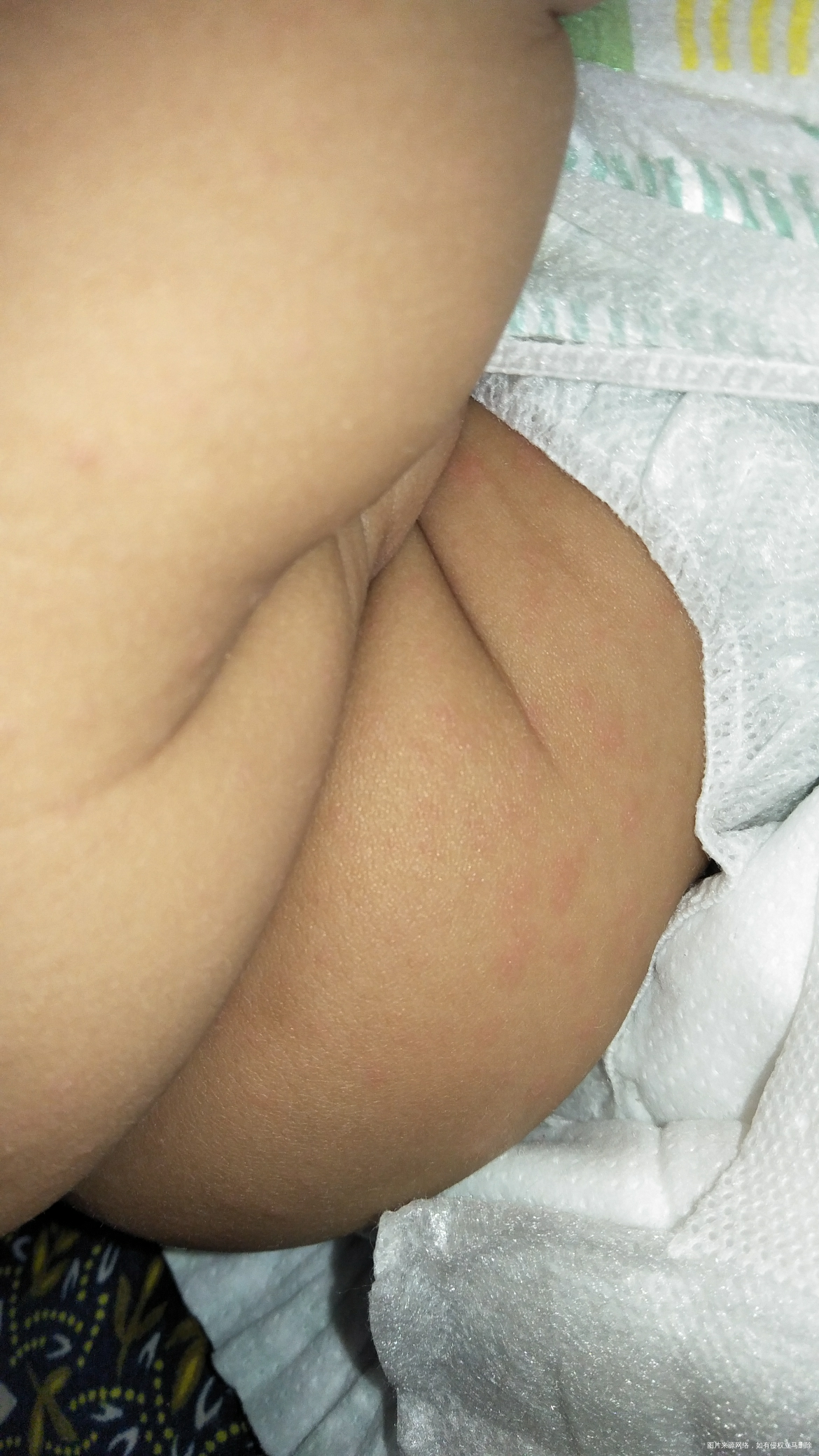 孩子手上最近多了几个白色的包