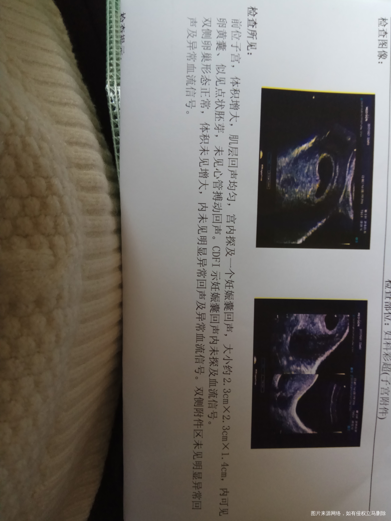 今天彩超的结果,是不是很不理想?好孕帮的医生们帮我看看。谢谢啦!!