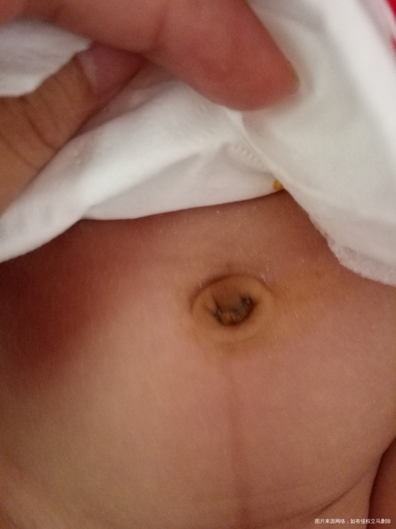 宝宝脐带是不是没掉干净