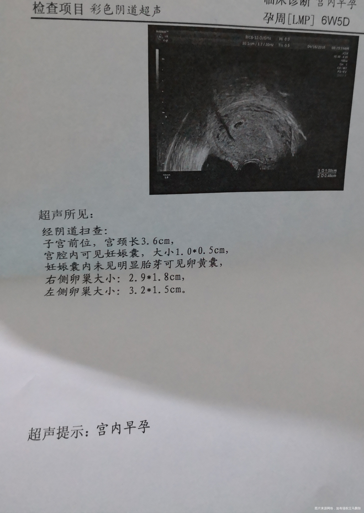 试管移植30天了,刚做了一超