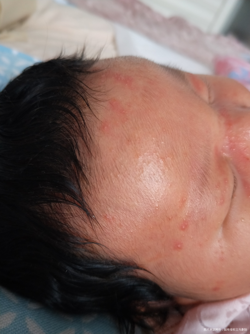 麻烦医生看看宝宝额头上是什么东西