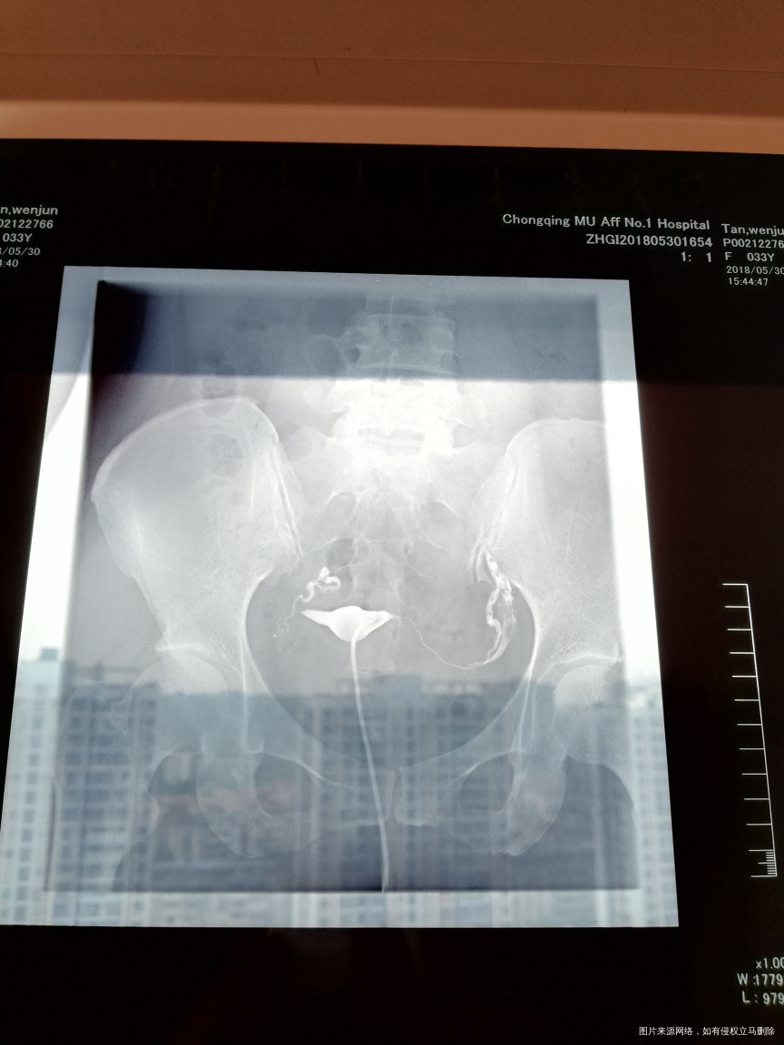 输卵管造影,双侧走行迂曲、僵硬,右侧末端弥散欠佳。