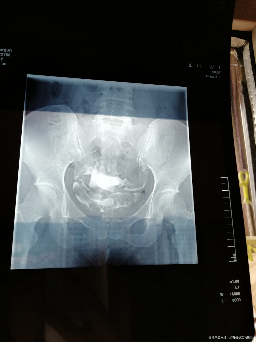 输卵管造影,双侧走行迂曲、僵硬,右侧末端弥散欠佳。