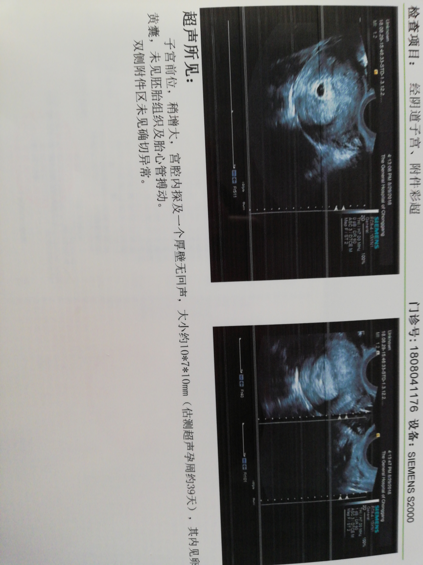 麻烦看看怀孕43天的b超
