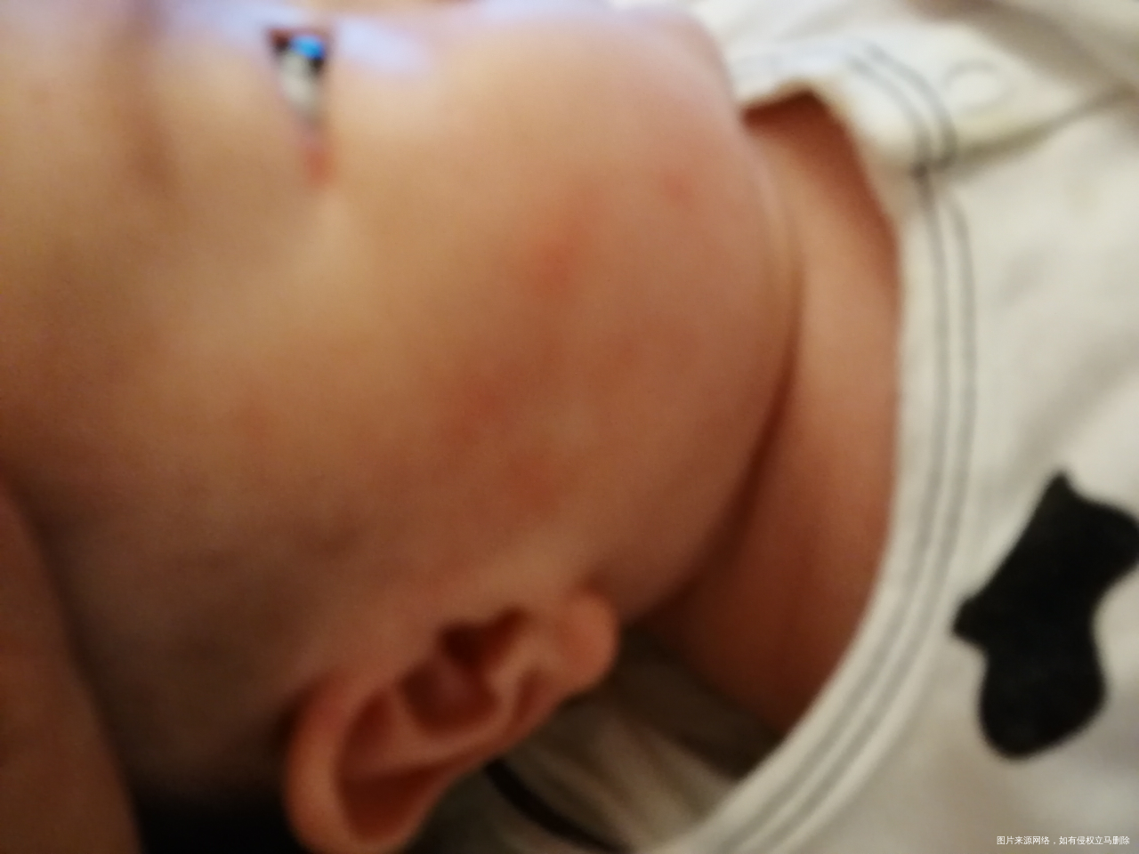 婴儿吃了施保利通片,身上起疹子