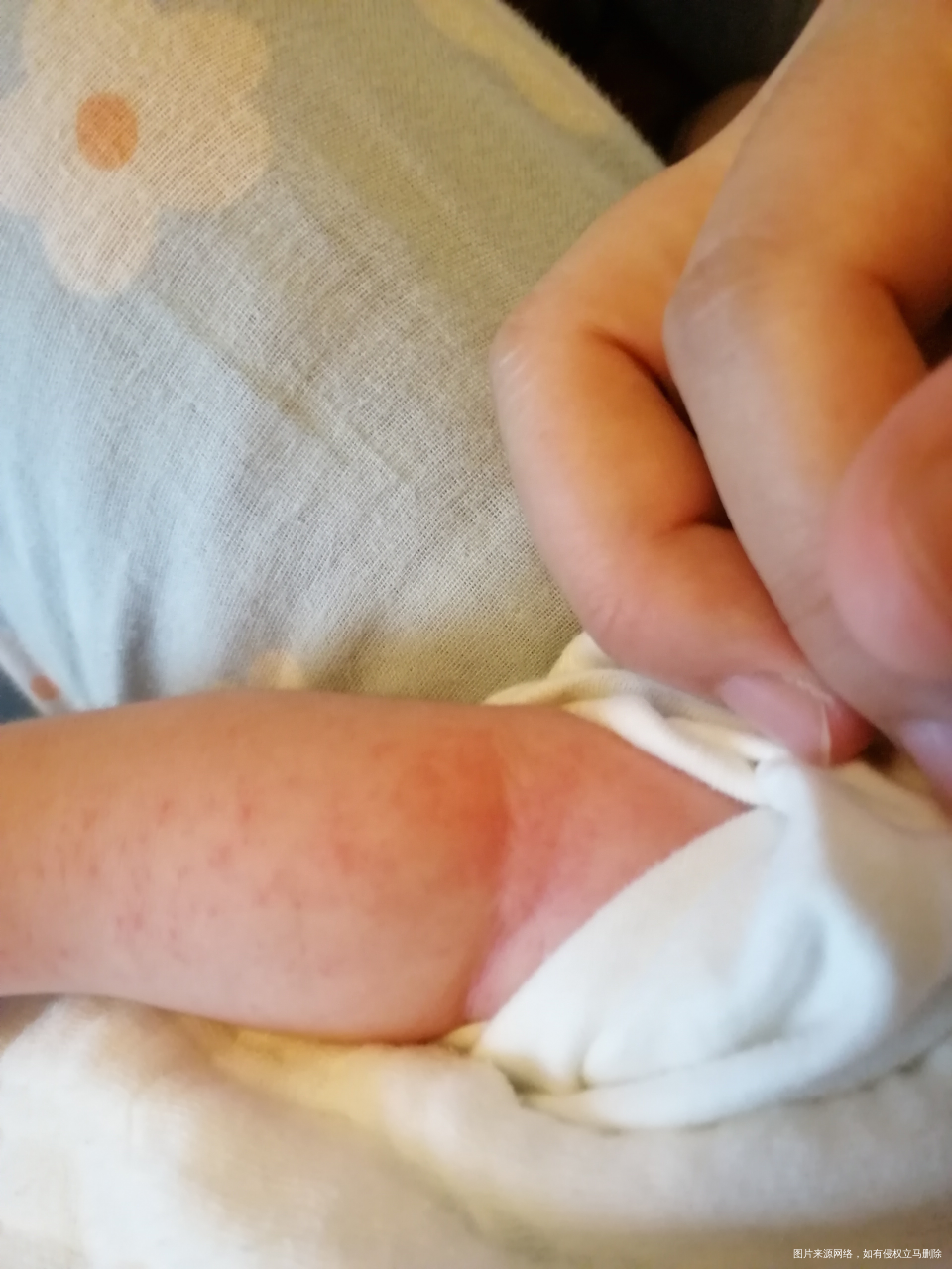 婴儿吃了施保利通片,身上起疹子