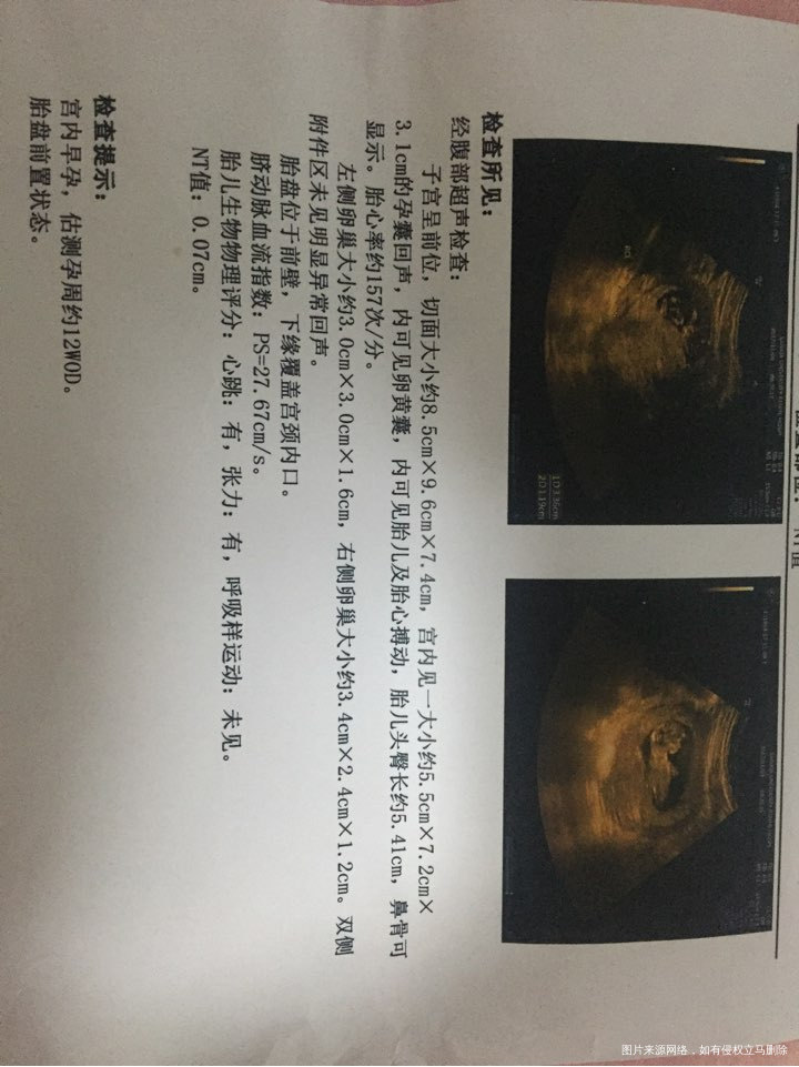 
今天NT检查胎盘有点下。有点小担心。不过算是试管医院正式毕业了