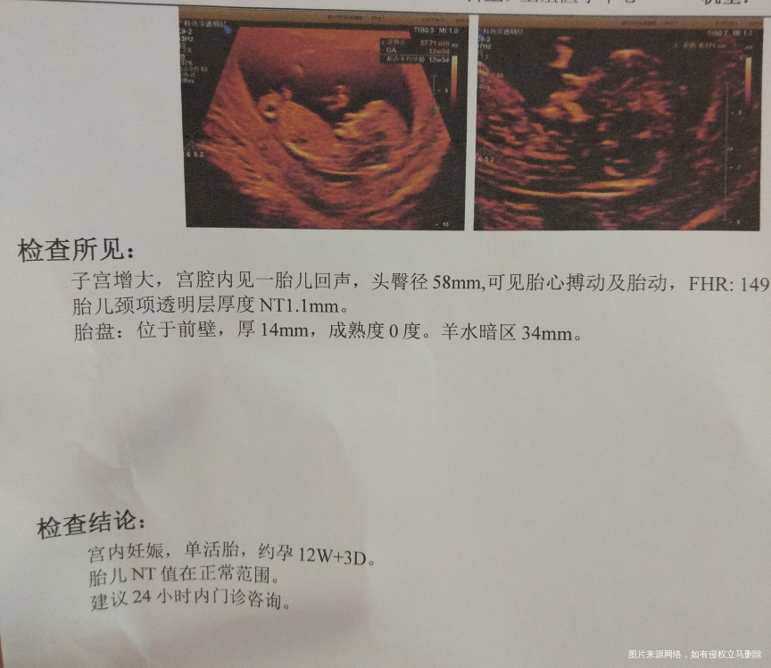 NT顺利通过,医生说二代试管要做无创?