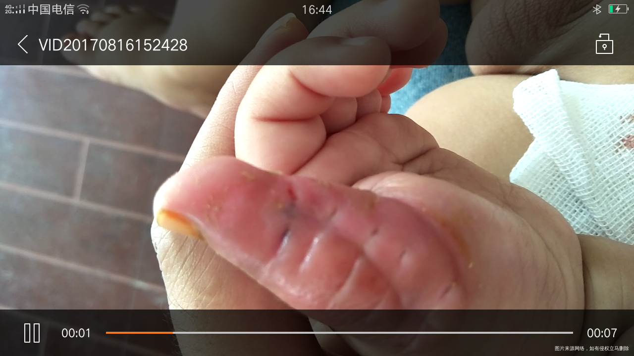 小孩手指手术后拆线里面残留一根