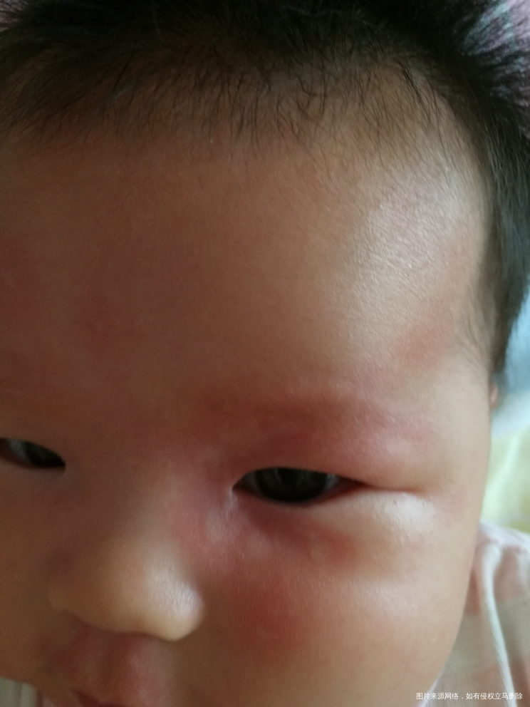 宝宝四个月大,最近得了荨麻疹,停药就起风团,吃药就好