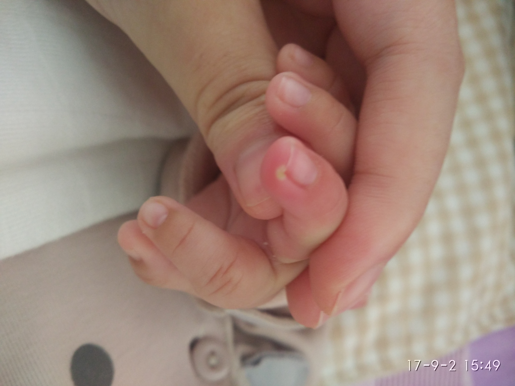 宝宝指甲断层是什么原因？需要做什么化验、检查吗？_手足口病 - 好大夫在线