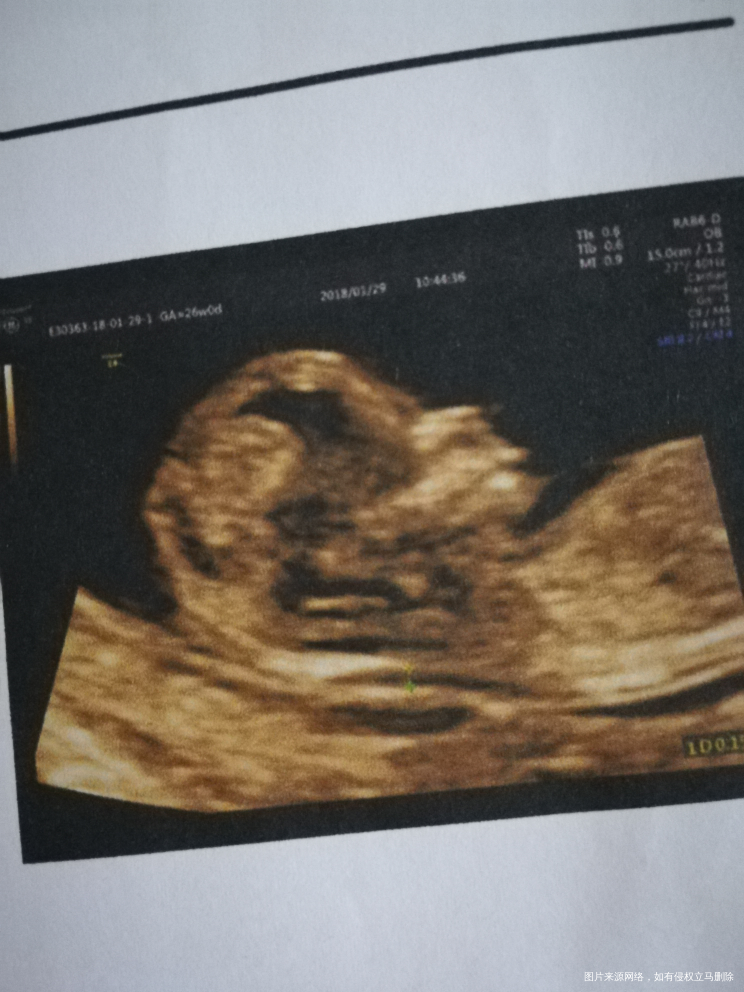 我怀啦 | 今天nt顺利通过啦,宝宝看起来很可爱。