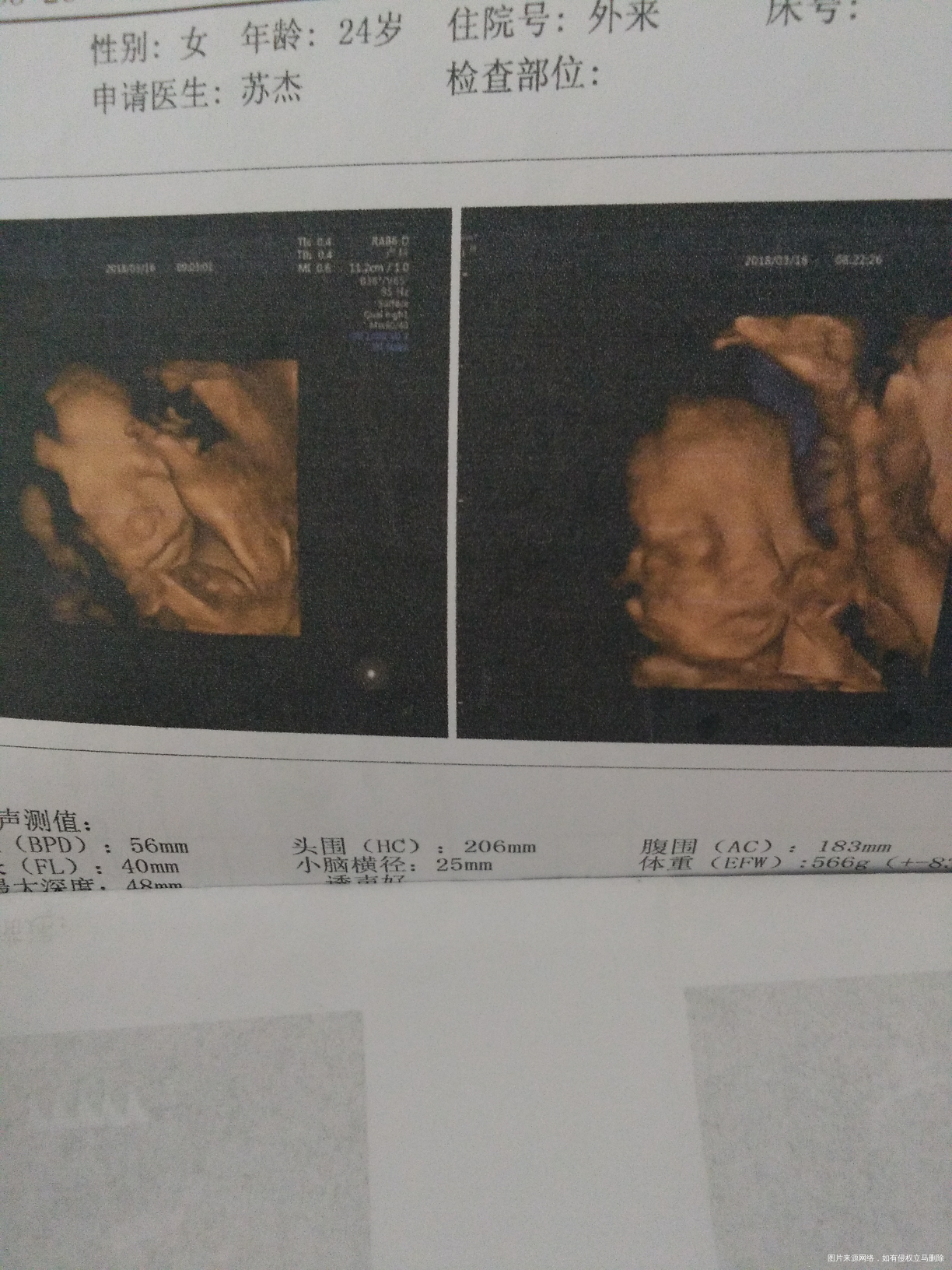 有些姐妹说宝宝四维彩超