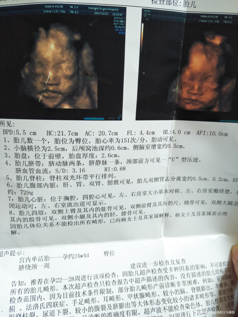 
四维归来,就是医生说比实际孕周小了,得多补充维生素了,孕妈看看像男还是像女呢…