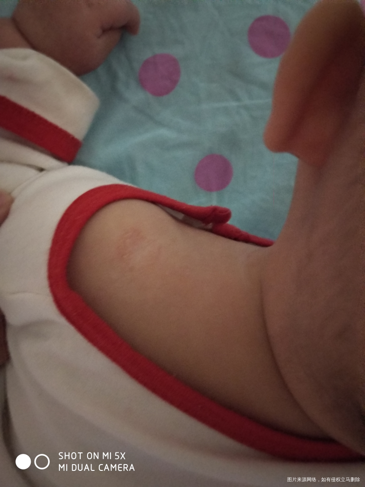 七个半月宝宝肩膀起癣怎么回事