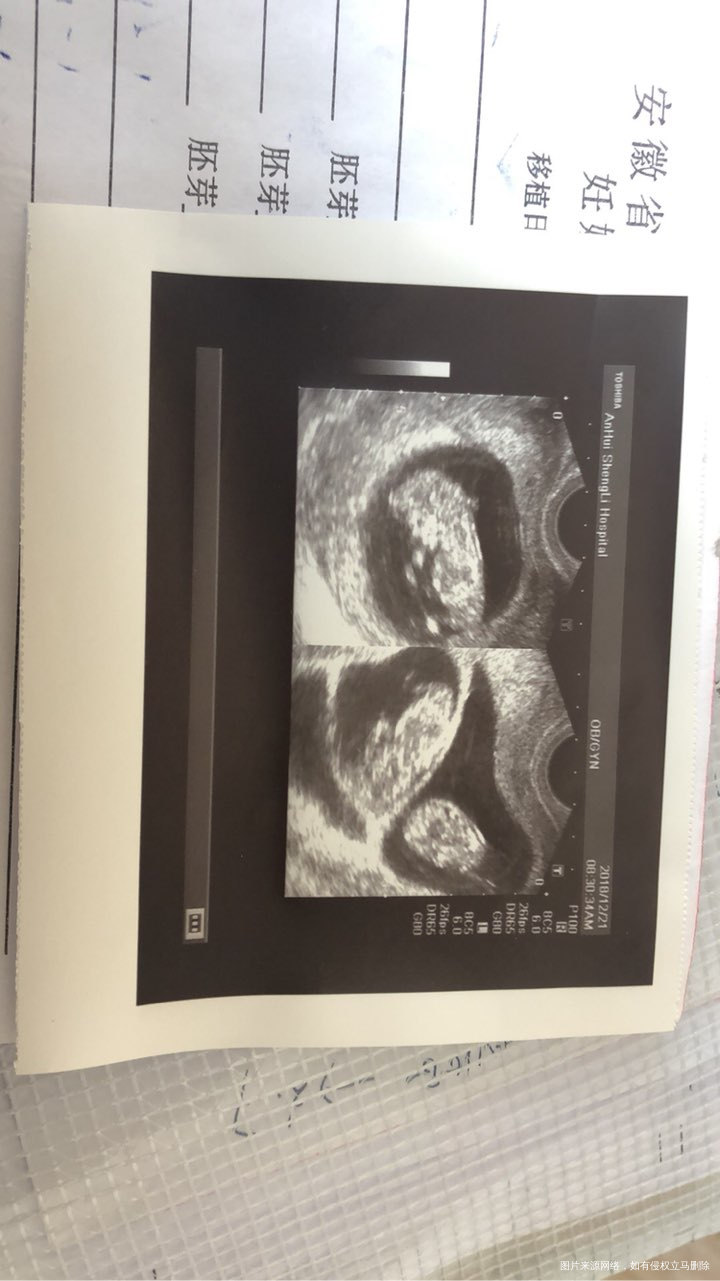 二超顺利通过,希望大家都能好孕