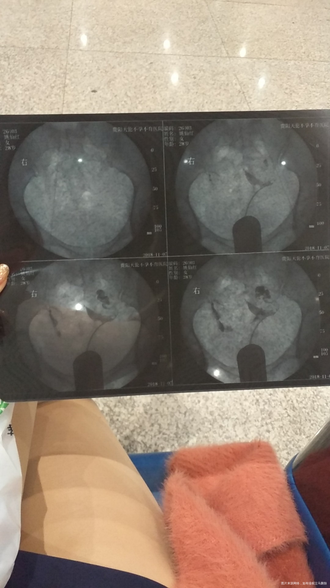 双侧输卵管不完全硬堵