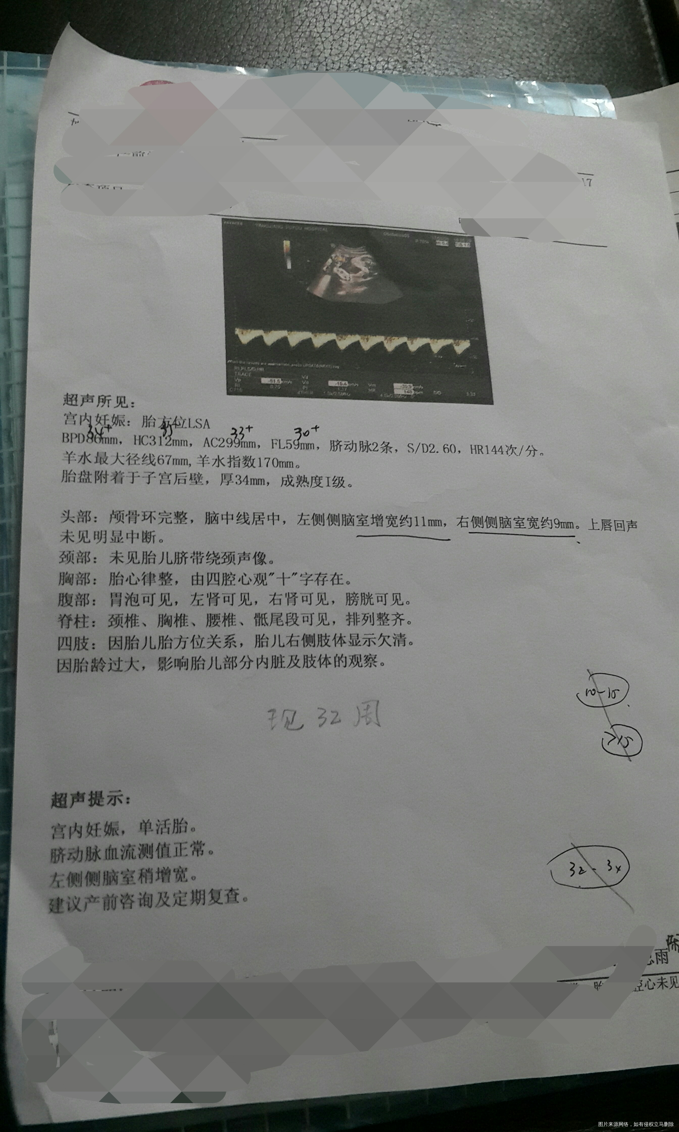 32周胎儿左侧侧脑室增宽11mm