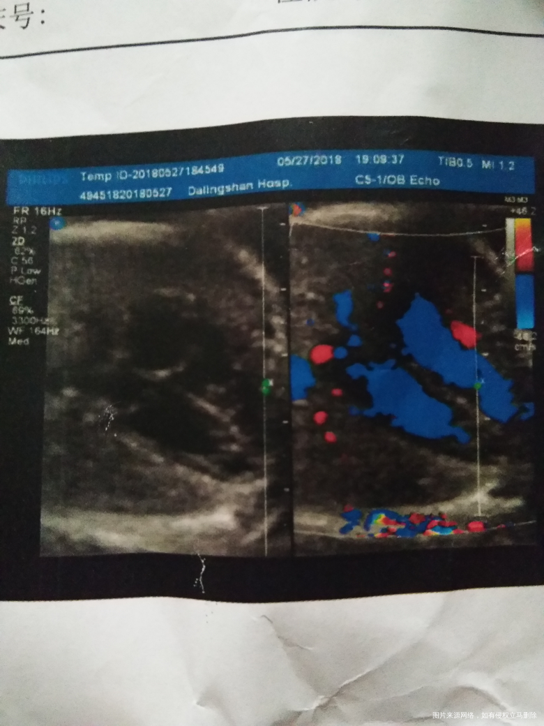 请医生帮忙看下我的糖筛和四维检查结果正常不,谢谢